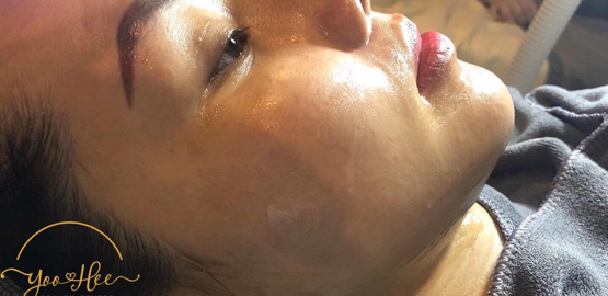 HIFU ULTHERAPY FOCUS